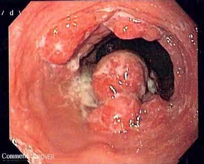 Viêm hang vị dạ dày biến chứng, bắt đầu hình thành khối u trong hang vị dạ dày (Hình ảnh nội soi)