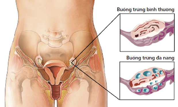 Bệnh đa nang buồng trứng gây đau bụng dưới phía trên trái